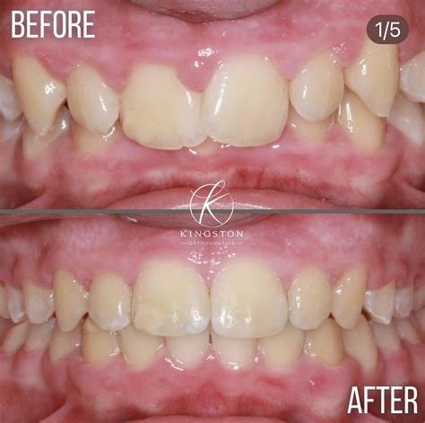 Discover How Braces Effectively Correct Overbites