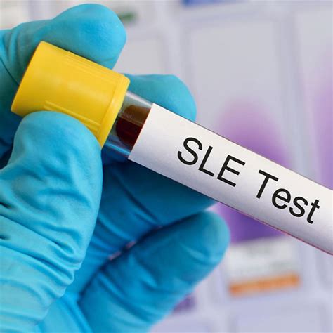 Lupus in Children & Teens: Parent FAQs - HealthyChildren.org