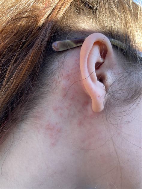 Allergic Reaction Bumps Behind Ears at Susan Jaimes blog