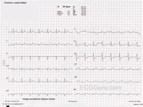 Isolated Posterior Wall M.I. | ECG Guru - Instructor Resources