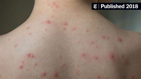 Chickenpox Outbreak at School Linked to Vaccine Exemptions - The New ...