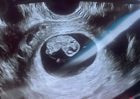 8 week scan | BabyCenter