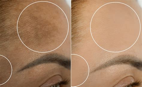 Forehead Tanning: धूप से माथा पड़ गया है काला तो आजमाइए दूध और बेसन का ...