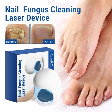 Toenail Light Treatment at Christy Redfield blog