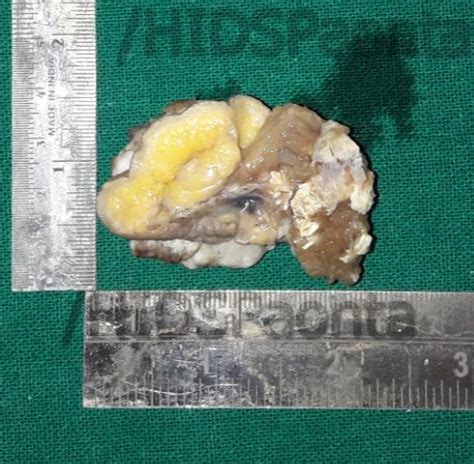 MDS | Oral Pathology | Himachal Institute of Dental Sciences