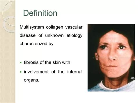 scleroderma-191009073259 (1).pdf