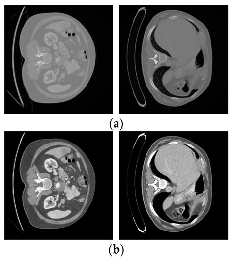 Liver Tumor Computed Tomography Image Segmentation Based on an Improved ...