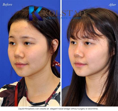 Non Surgical Asian Rhinoplasty San Diego Before & After Gallery 1 | Dr ...