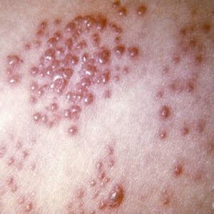 See related image detail. Herpes Photograph by Science Source - Fine Art America