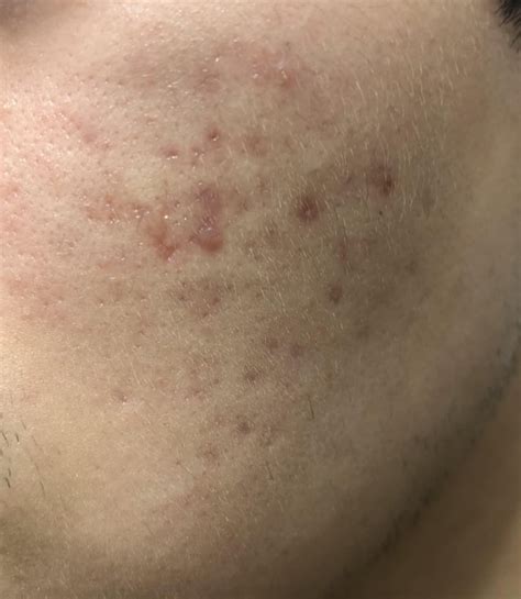 Image result for Blood Red Pimple