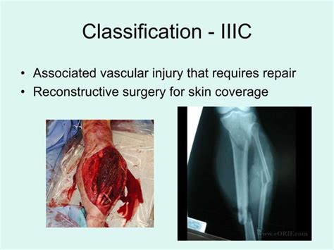 Image result for Open Fracture Surgery