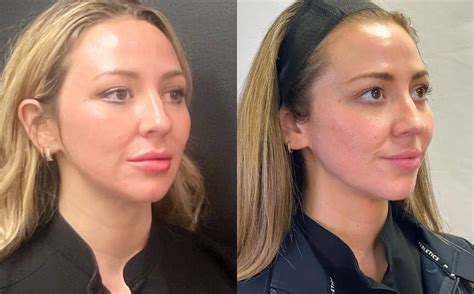 Image result for Thread Lift