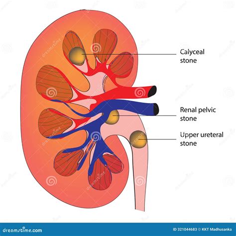 Renal calculi stock vector. Illustration of ureteroscope - 321044683