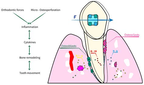 Acceleration Techniques for Teeth Movements in Extractive Orthodontic Therapy