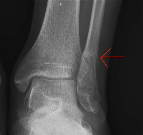 Fibula Stress Fracture The Radiology Assistant : Stress Fractures
