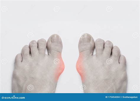 Surgical Removal Of Pyogenic Granuloma On Skin Royalty-Free Stock Photography | CartoonDealer ...