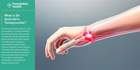 De Quervains Tenosynovitis Fact Sheet