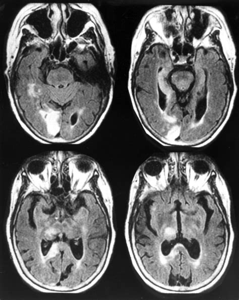 Image result for Alien Hand Syndrome Documentary