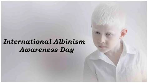 International Albinism Awareness Day: Let’s embrace diversity