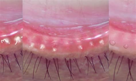 Smoking-Related MGD: Antioxidant & Lipid Drops Offer Better Long-Term ...