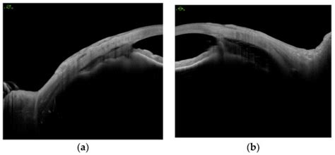 Encircling Scleral Buckling Surgery for Severe Hypotony with Ciliary ...