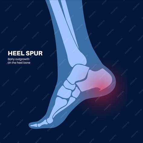 Bone Spur In Foot