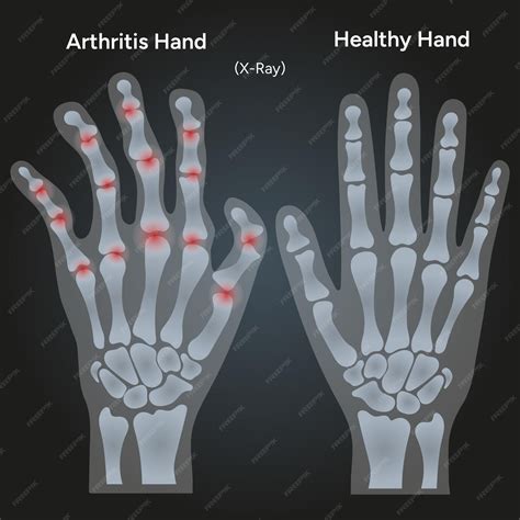 La artritis reumatoide y las radiografías de manos humanas sanas ...