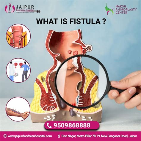 What is a fistula? - Causes and Types