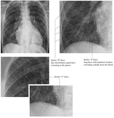 Chest Xray interpretation in ICU | Deranged Physiology