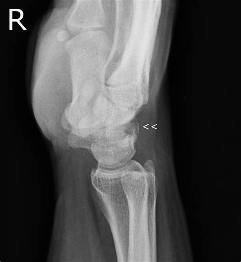 File:Triquetral fracture (Radiopaedia 50260-55614 Lateral view of wrist - cropped, magnified ...
