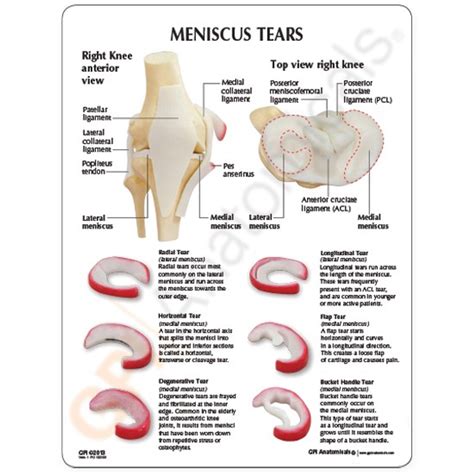 Knee Anatomy Model-Meniscus Tears - Clinical Charts and Supplies
