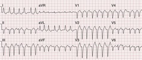 Image result for AFib Detection Algorithm