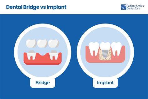 Dental Bridge vs Implant | Cost Comparison & Benefits Explained