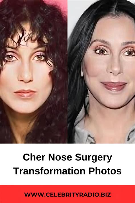 Cher Face Surgery