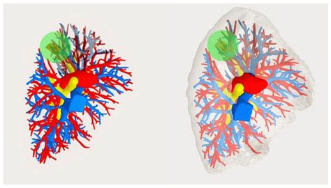 Three-Dimensional Imaging-Guided Lung Anatomic Segmentectomy: A Single ...