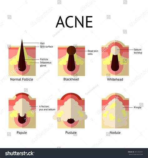 Types Of Acne Pimples. Healthy Skin, Whiteheads And Blackheads, Papules And Pustules In Flat ...