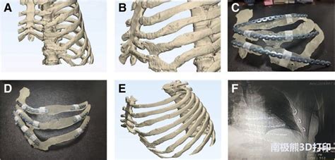 石家庄第三医院利用3D打印改善肋骨骨折手术-aau3d打印
