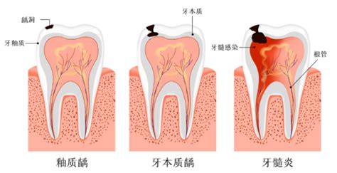 牙髓炎图片 (29)_有来医生