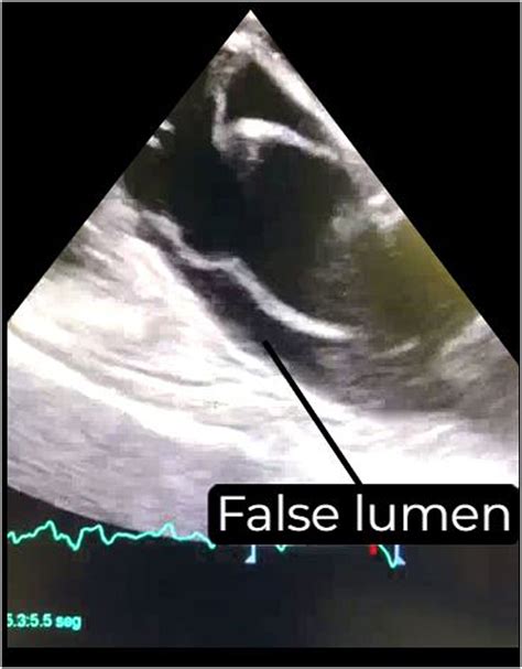 Transesophageal echocardiography during cardiopulmonary resuscitation: Another tool | Medicina ...