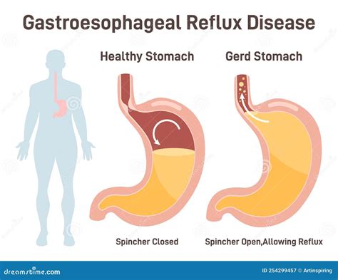 Heartburn or Gastroesophageal Reflux Disease. Stomach Acid Stock Illustration - Illustration of ...
