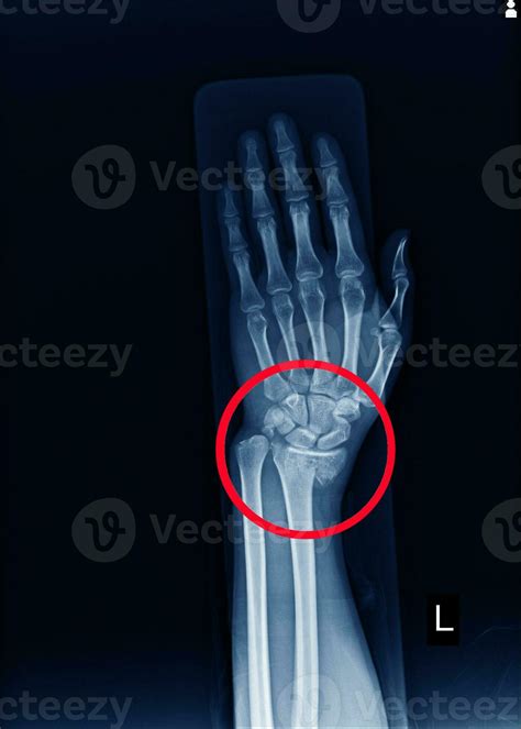 Wrist Joint Fracture X Ray at Julia Cupp blog