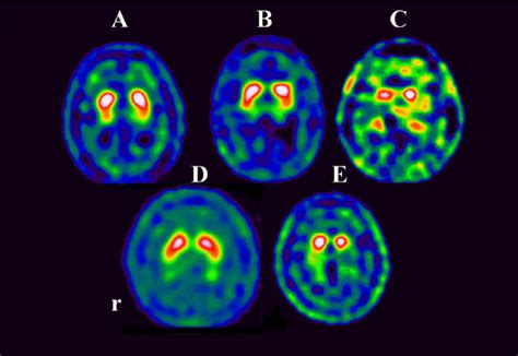 Rezultat imagine pentru Dat Brain Scan
