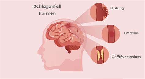 Bekomme ich einen Schlaganfall bei hohen Blutdruck?