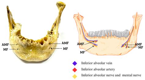 Morphological Characteristics of the Double Mental Foramen and Its Relevance in Clinical ...