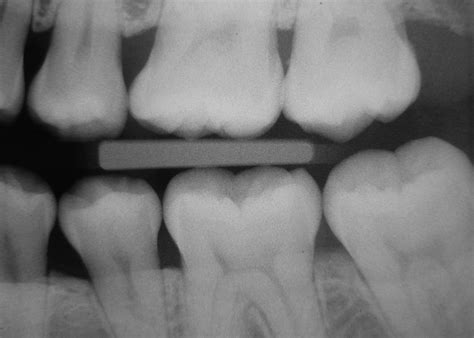ARE DENTAL X-RAYS NECESSARY? 8 REASONS WHY THEY'RE IMPORTANT - bitewing x ray