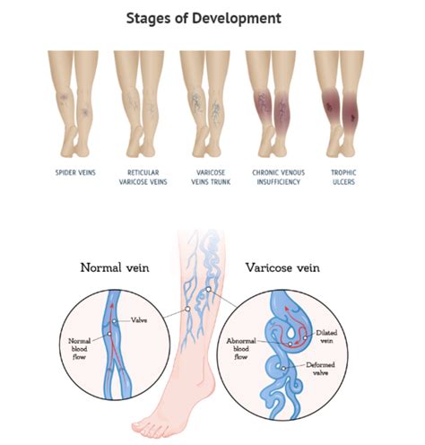Leg Swelling Venous Insufficiency at Margaret Cass blog