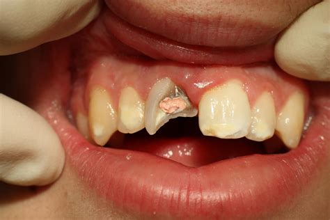 Image result for Broken Tooth