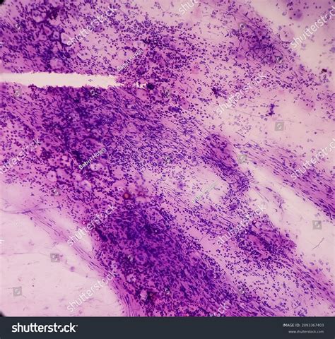 Atypical Squamous Cells Pap