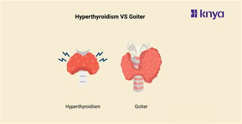 Difference Between Hyperthyroidism and Goiter | Explained! – Knya