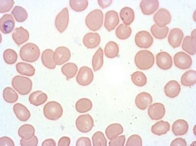Plasmodium Falciparum from Images of Giemsa for Malaria Detection ...